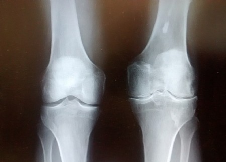 דיקור סיני לטיפול בכאב אחרי ניתוחים להחלפת מפרק