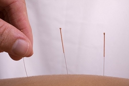 שיטות טיפול ברפואה סינית שיטות טיפול ברפואה סינית